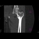 Osteoid osteoma: CT - Computed tomography